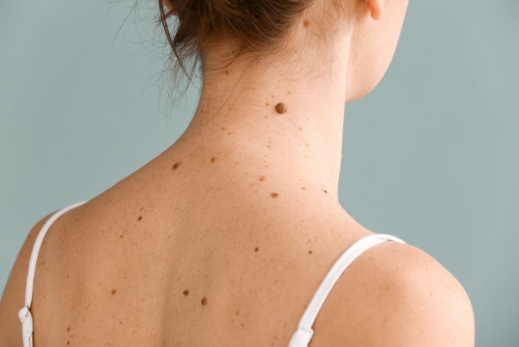 Skin growths: A picture of moles on a girl's back