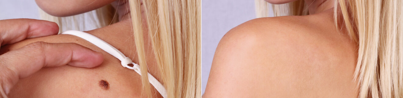 wart-removal-brisbabe