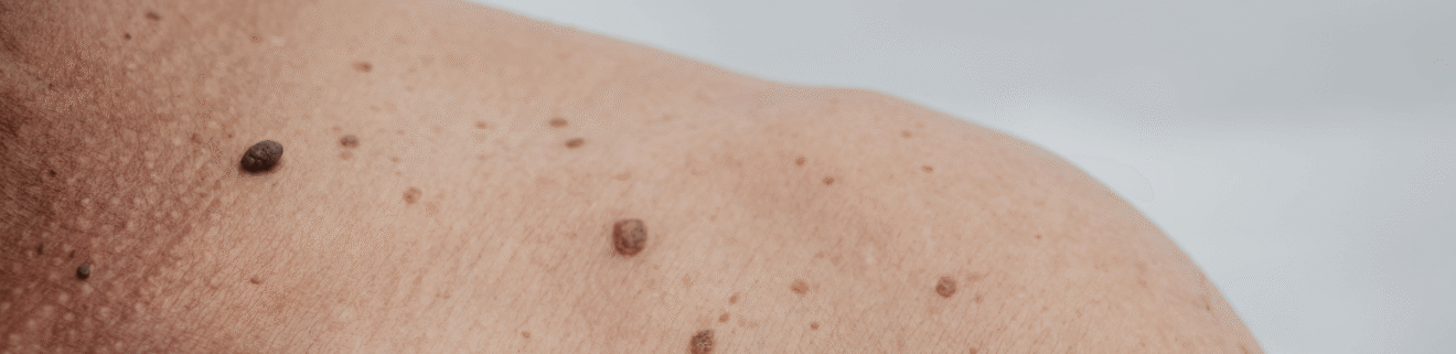 regular skin check blog