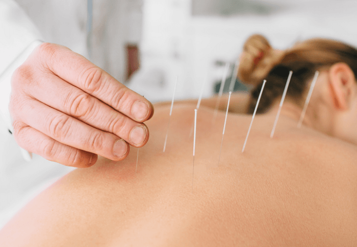 Doctor puts acupuncture needles into woman's back