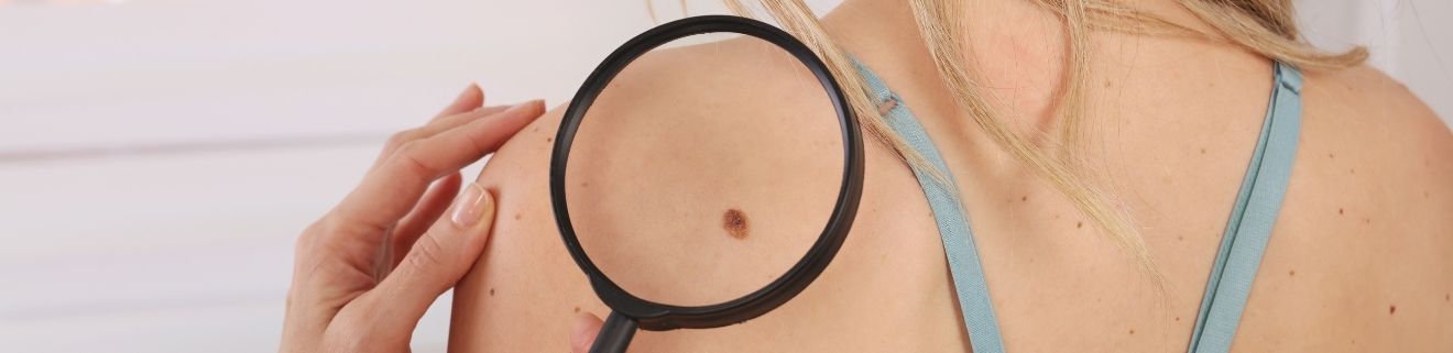 skin check tips