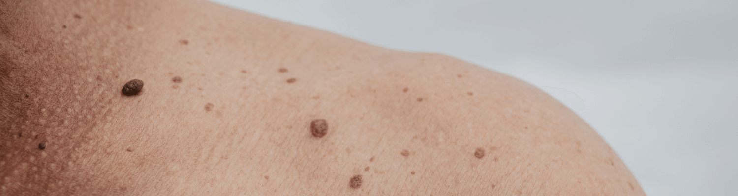 skin check brisbane